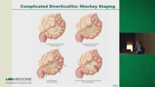 What is diverticulitis Causes symptoms treatment amp more [upl. by Riva]