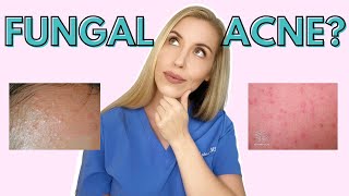 Do YOU have Fungal Acne  Dermatologist Talks Symptoms and Treatments [upl. by Einhorn103]