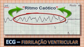 Premature Ventricular Contractions PVC Interpretation Easy and Simple [upl. by Hunt]