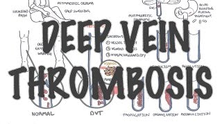 Deep Vein Thrombosis  Overview pathophysiology treatment complications [upl. by Alber458]