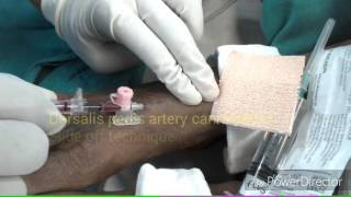 Dorsalis pedis artery cannulation [upl. by Undine676]