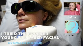 I TRIED THE FOREVER YOUNG BBL LASER FACIAL  HERE ARE MY RESULTS [upl. by Charis]