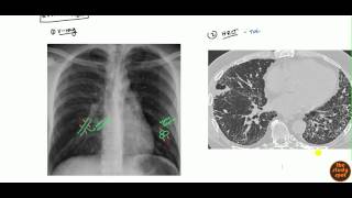 Chronic Obstructive Pulmonary Disease COPD [upl. by Zorine]