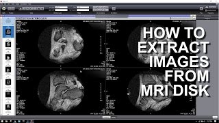 HOW TO EXTRACT IMAGES FROM A MRI DICOM DISK [upl. by Itteb68]