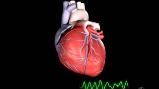 US QA echo ventricular fibrillation [upl. by Novaj649]