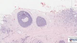 Oral Squamous Cell Carcinoma Staging System [upl. by Carolan]