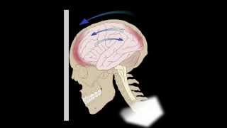 Common Brain Injuries Coupcontracoup [upl. by Sirama]