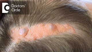 What causes Sebaceous Cyst on the scalp  Dr Nischal K [upl. by Florrie]