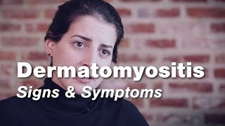 Dermatomyositis – Signs amp Symptoms  Johns Hopkins [upl. by Tonneson]