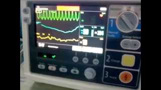 Atrial Fibrillation Afib  EKG ECG Interpretation [upl. by Nehtiek893]