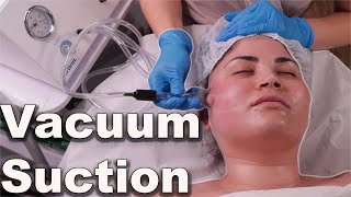 Vacuum suction facial treatment  avoid pore bruising step by step demo 2021 [upl. by Kohl]