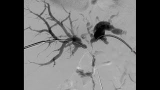 Percutaneous Transhepatic Cholangiography and Drainage PTCD [upl. by Holmun445]