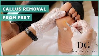 Callus removal from feet balls of feet [upl. by Wilona920]