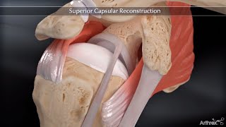 Superior Capsular Reconstruction Animation [upl. by Naegem]