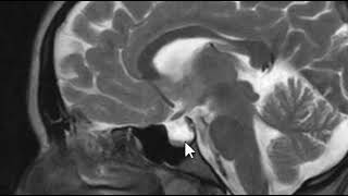 Removal of kidney stones PCNL [upl. by Richelle]