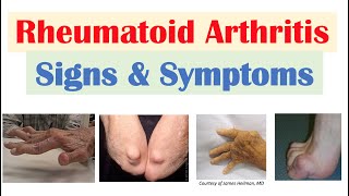 Rheumatoid Arthritis RA Signs amp Symptoms amp Associated Complications [upl. by Fulbright]