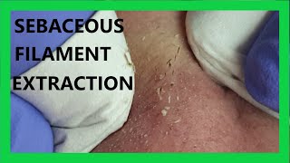 Sebaceous FILAMENT Extraction [upl. by Zeculon]