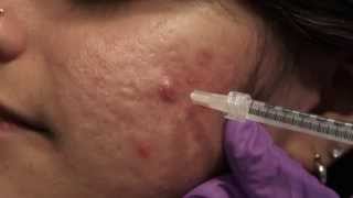 Watch amp Learn Intralesional injections [upl. by Lynn53]