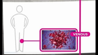 Venous Thrombosis Explained [upl. by Noremac952]