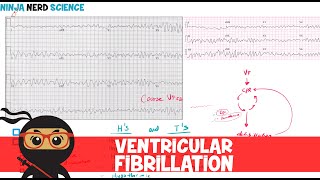 What is Ventricular Fibrillation [upl. by Gerstner378]