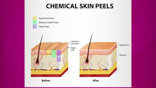 Chemical Peel Purpose amp Types [upl. by Holladay]