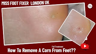 Corns amp Calluses  Symptoms amp How To Get Rid Of Them [upl. by Rickie464]