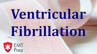 Ventricular Tachycardia in Cardiac Monitor [upl. by Aran]