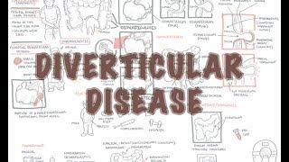 Diverticular Disease diverticulitis  Overview [upl. by Arolf724]