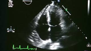 Ventricular fibrillation under ULTRASOUND [upl. by Ilahtan421]