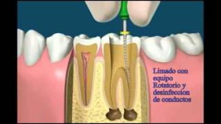 Caries endodoncia endoposte y corona [upl. by Hull491]