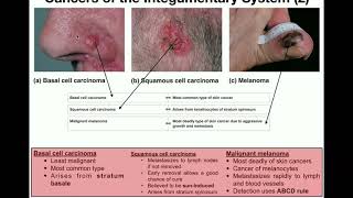 Finding and Removing Tongue Cancer [upl. by Enortna]