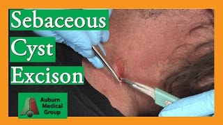 Sebaceous Cyst Removal  Auburn Medical Group [upl. by Akcirred]