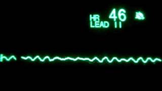 Fine Ventricular Fibrillation [upl. by Rothwell516]