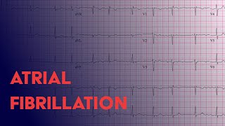 Eletrocardiograma  análise  flutter atrial [upl. by Asela]