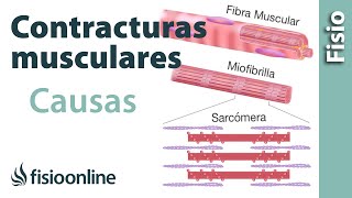 Contracturas musculares  Cómo suceden y cuáles son sus causas [upl. by Ettenyl213]