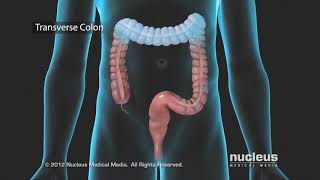 Diverticulitis Diet  WebMD [upl. by Marucci]