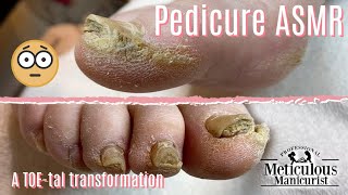 👣Pedicure ASMR on Extremely Calloused Feet👣 [upl. by Faustus]