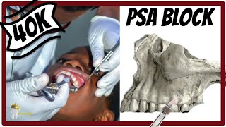 POSTERIOR SUPERIOR ALVEOLAR NERVE BLOCK TECHNIQUE  Tuberosity block [upl. by Soisatsana35]