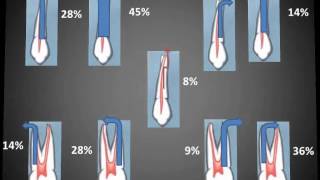 Primer premolar superiorwmv [upl. by Lester698]