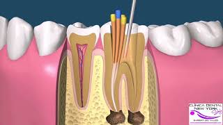 ENDODONCIA MANUAL POSTE COMPO CORONA [upl. by Ahtnams]