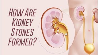 Removal of kidney stones URS [upl. by Ribble]