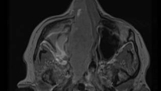 Lobular Carcinoma Breast  Histopathology [upl. by Ttnerb]