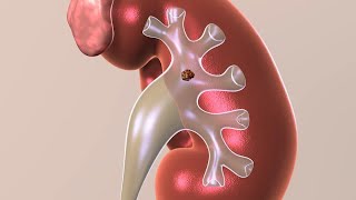 Acute Kidney Injury AKI  USMLE [upl. by Alag]