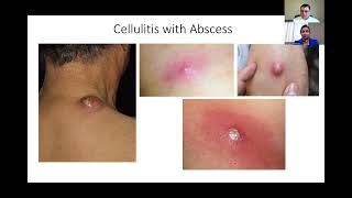 Diagnosis and Treatment of Cellulitis [upl. by Stover]