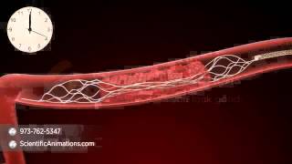 Mechanical Thrombectomy  Neurovascular stent deployment [upl. by Airahcaz337]