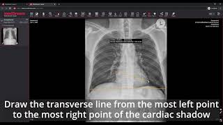 MedDream DICOM Viewer measure a cardiothoracic ratio [upl. by Ardnoek]