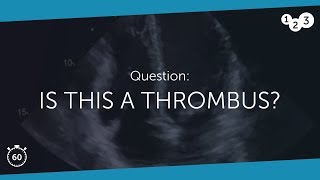 60 Seconds of Echo Teaching Question A thrombus [upl. by Rech]