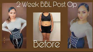 BBL 2 Week Post Op Update  Body Reveal  BBL Arm and Chin Lipo  305 plastic Surgery [upl. by Buroker229]