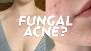 What is Fungal Acne We Discuss Skincare Treatments Causes amp More [upl. by Nahtnhoj]