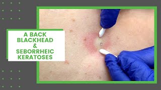 A Back Blackhead amp Seborrheic Keratoses  Dr Derm [upl. by Eintrok]